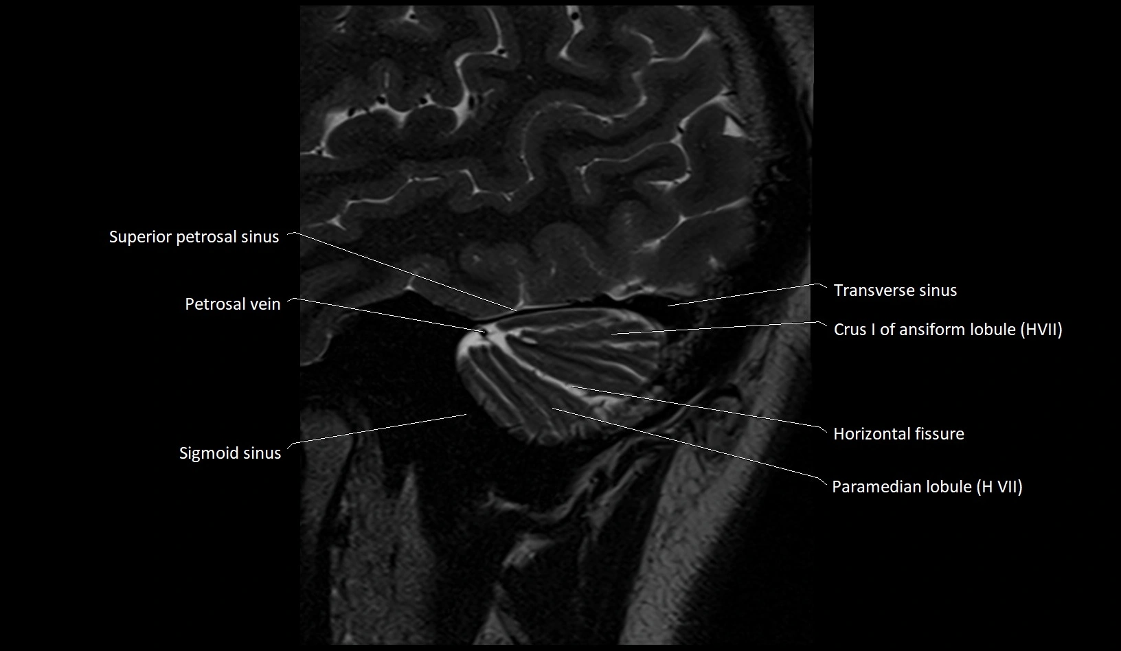 MRI Cerebellar anatomy sagittal High-resolution labelled image 5.webp